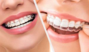 اقدامات لازم قبل از درمان ارتودنسی