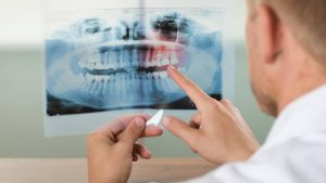 اقدامات لازم قبل از درمان ارتودنسی