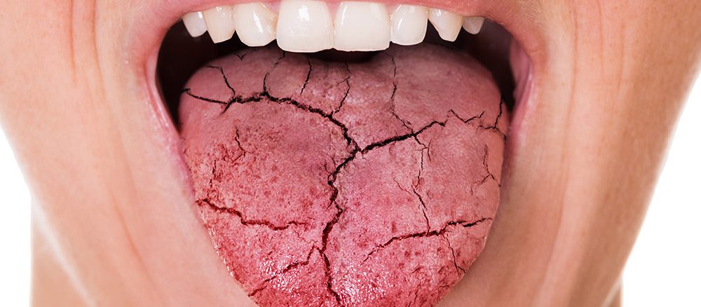 چهار علت و درمان خشکی دهان