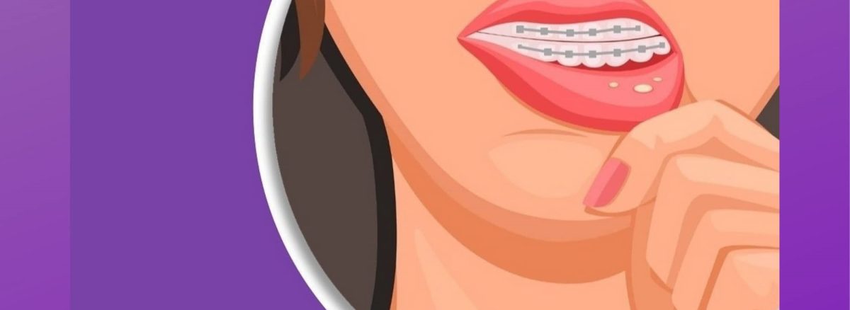 آفت دهان حین ارتودنسی