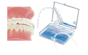 آفت دهان حین ارتودنسی