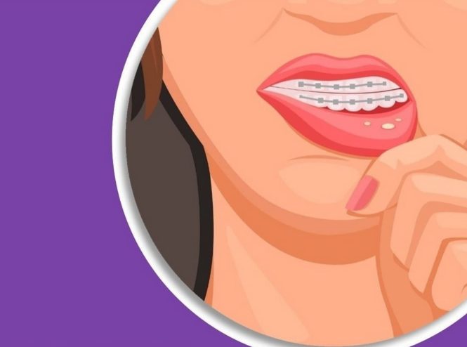 آفت دهان حین ارتودنسی