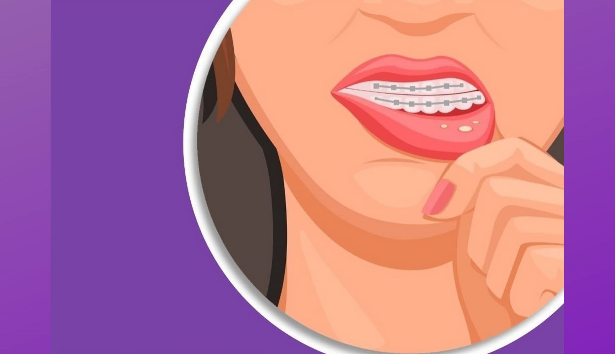 آفت دهان حین ارتودنسی