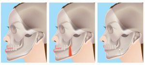 ارتودنسی جراحی