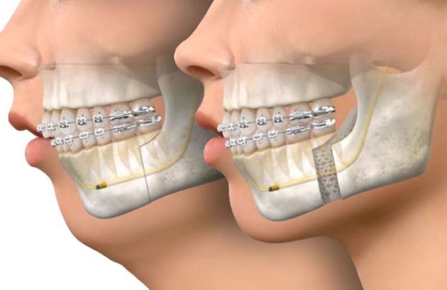 ارتودنسی جراحی