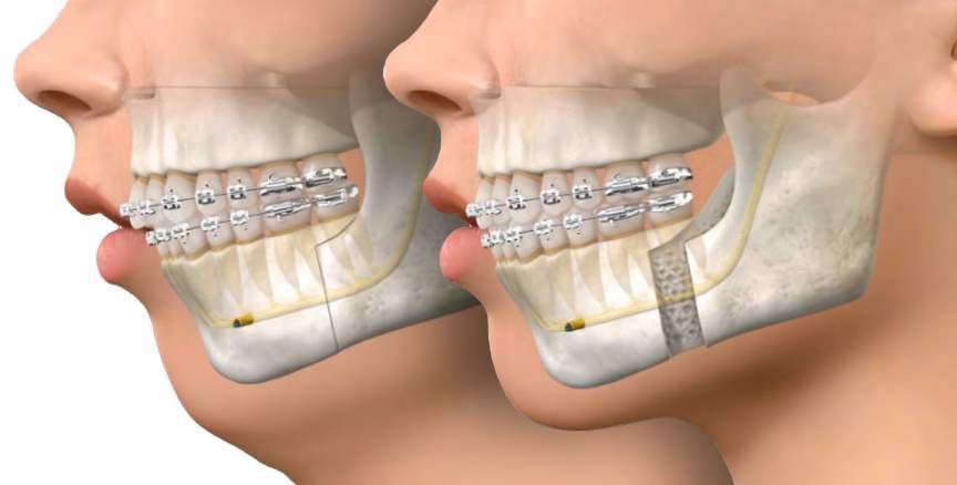 ارتودنسی جراحی