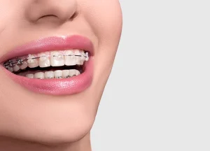 ارتودنسی یا لمینت دندان