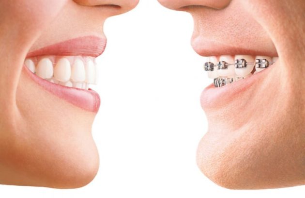 ارتودنسی یا لمینت