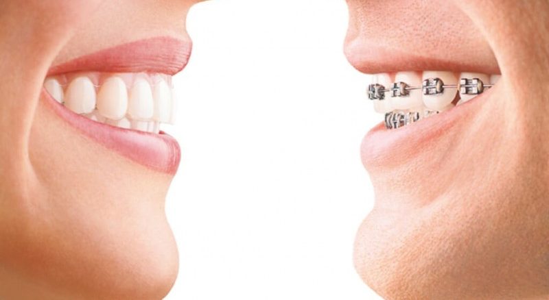 ارتودنسی یا لمینت