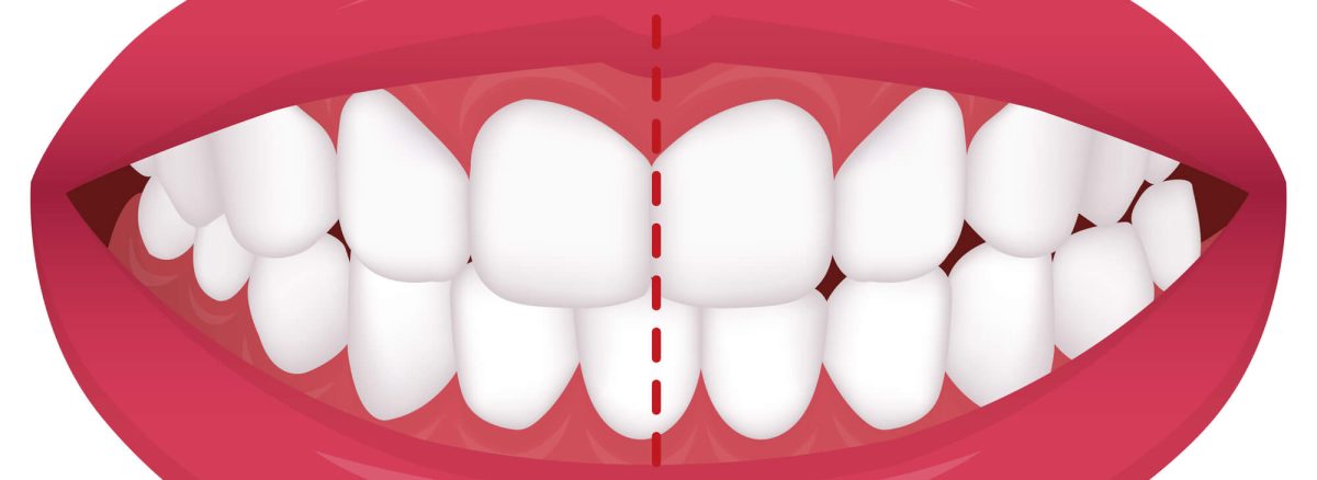 انحراف میدلاین