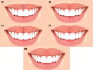 انحراف میدلاین