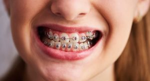 درمان لبخند لثه ای