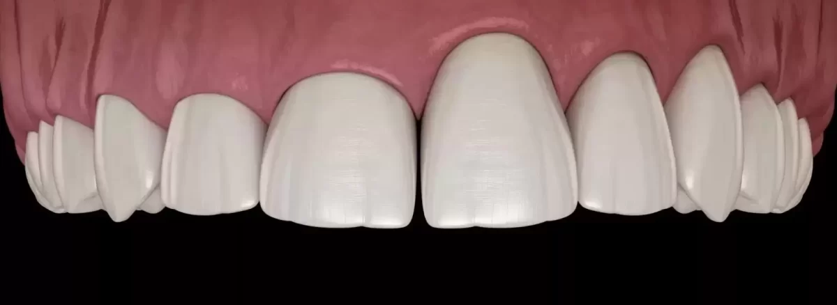 دندان میخی شکل