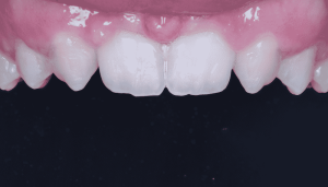 دندان میخی شکل