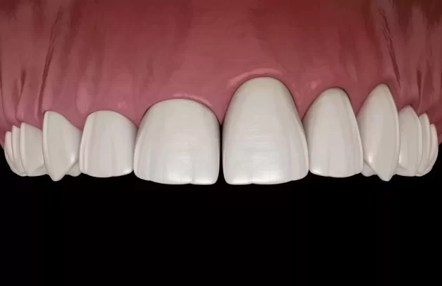 دندان میخی شکل