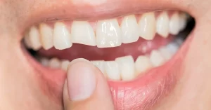 لب پریدگی دندان