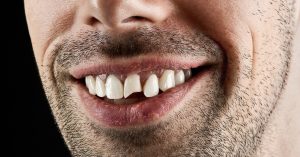 لب پریدگی دندان