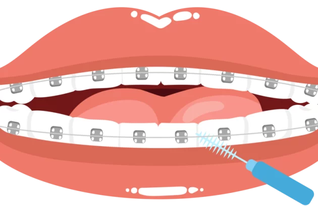 مسواک بین دندانی ارتودنسی