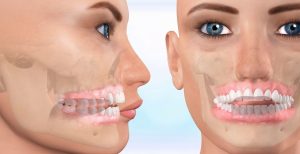 نامرتبی دندان ها