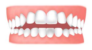 نامرتبی دندان ها