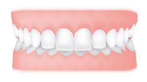 نامرتبی دندان ها