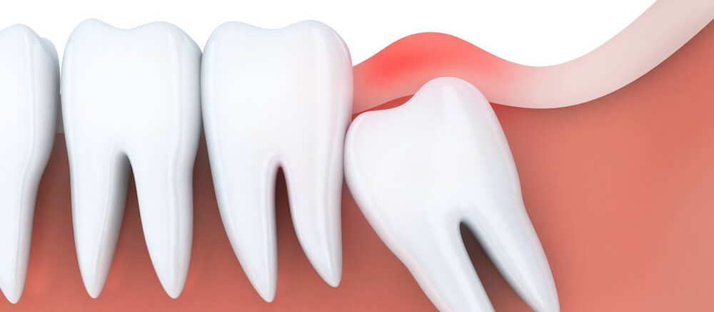 کشیدن دندان برای ارتودنسی دندان