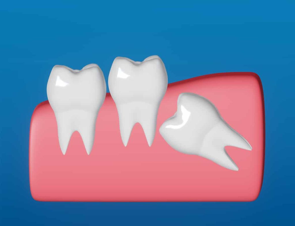 کشیدن دندان برای ارتودنسی دندان