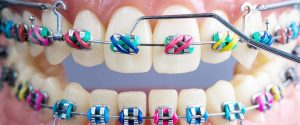 عوارض درمان ارتودنسی