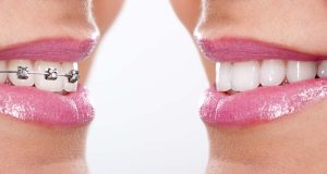 اصلاح طرح لبخند