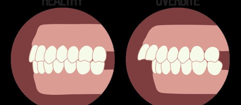 عوارض مکیدن انگشت