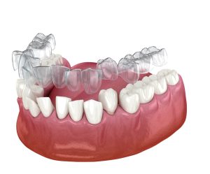 ارتودنسی اینویزیلاین