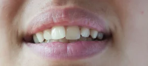 ارتودنسی تک دندان