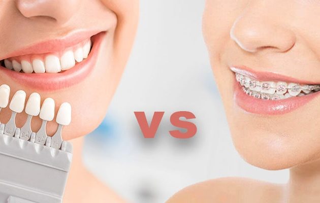 ارتودنسی یا کامپوزیت