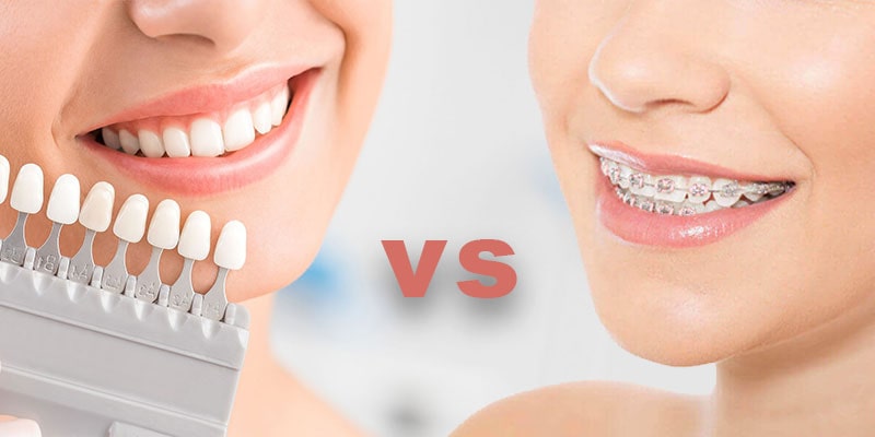 ارتودنسی یا کامپوزیت