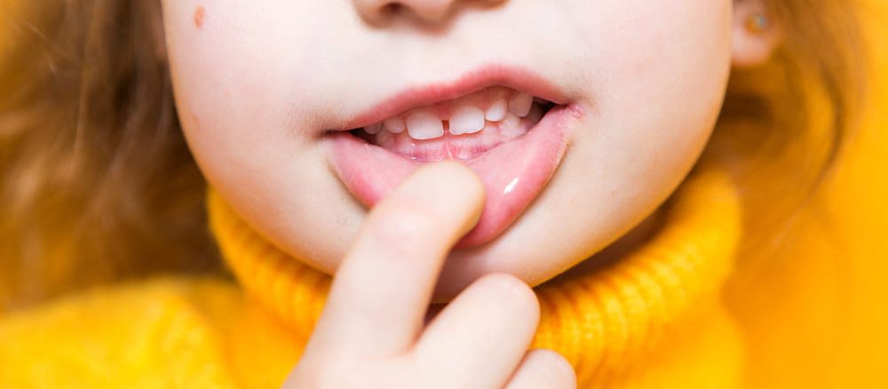 دندان خرگوشی