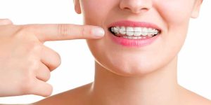 زرد شدن دندان