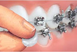 موم ارتودنسی