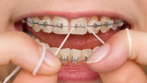 نخ دندان ارتودنسی