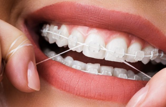 نخ دندان ارتودنسی