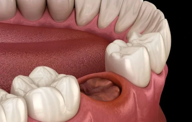 حفره خشک دندان