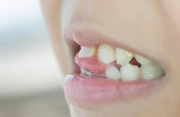 لق شدن دندان دائمی