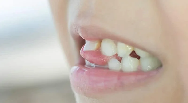 لق شدن دندان دائمی