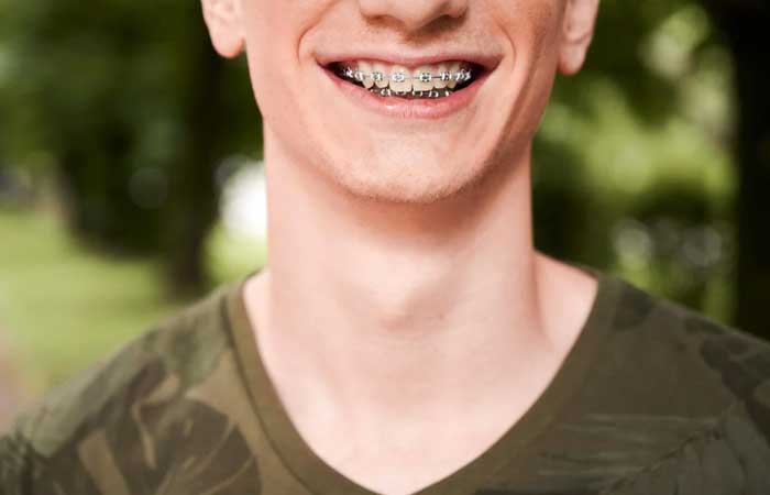 آیا ارتودنسی شامل بیمه می شود