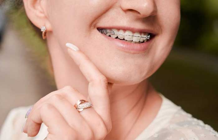 تا چند سالگی می توان ارتودنسی کرد؟