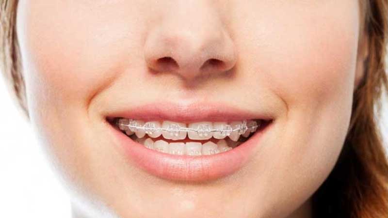 ارتودنسی زود بازده خوب است یا بد