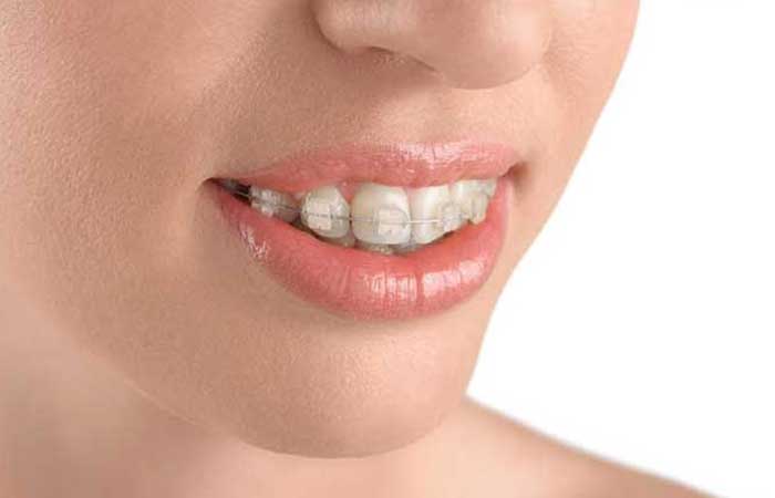 چه نوع ارتودنسی بهتر است؟