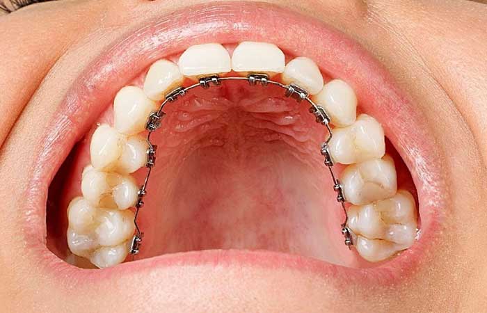 چه نوع ارتودنسی بهتر است؟