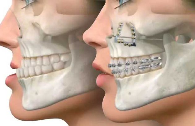 فرق ارتودنسی با ارتوسرجری