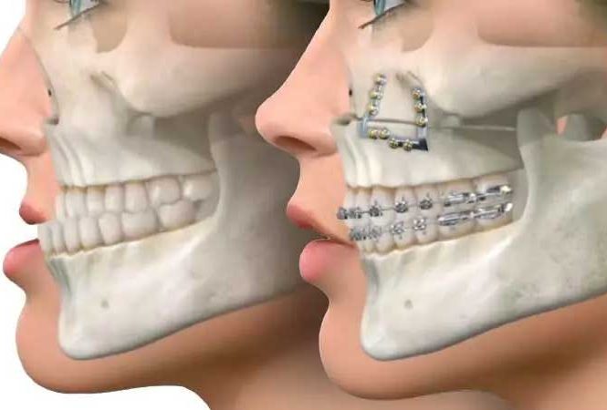 فرق ارتودنسی با ارتوسرجری