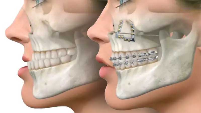 فرق ارتودنسی با ارتوسرجری